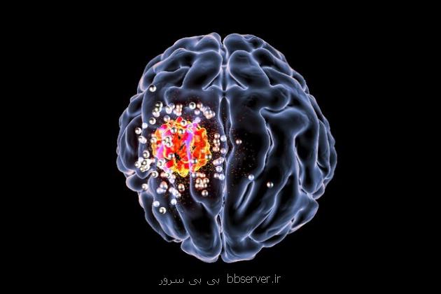 موفقیت یک کاوشگر جدید در تشخیص متاستاز سرطان مغز
